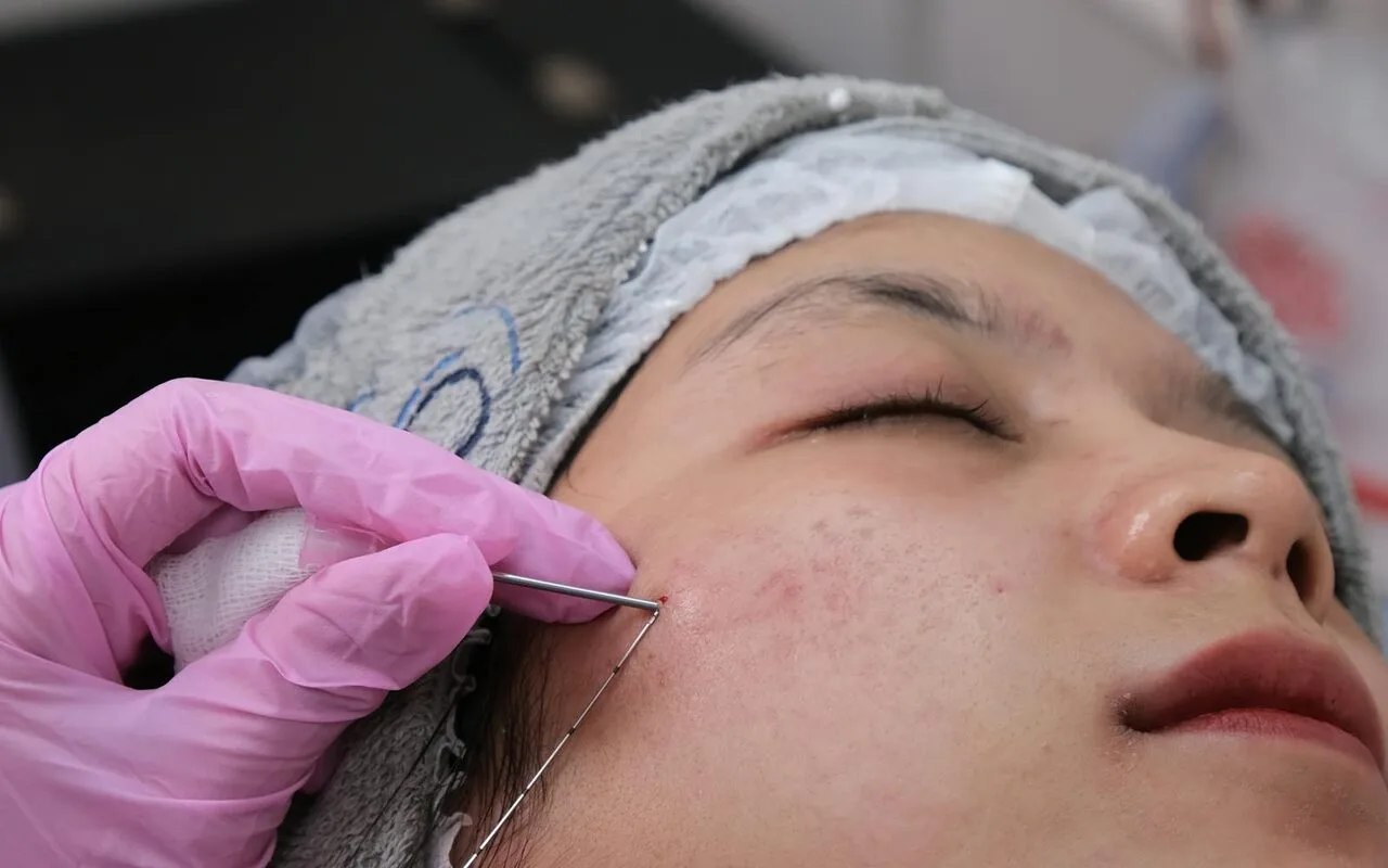 Microneedling at Aesthetics Universe Med Spa in Anaheim, CA
